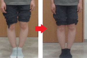 O脚改善　6月 400
